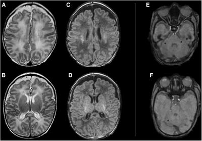 Neonatal hypoxic-ischemic encephalopathy after acute carbon monoxide intoxication during pregnancy. A case report and brief review of the literature